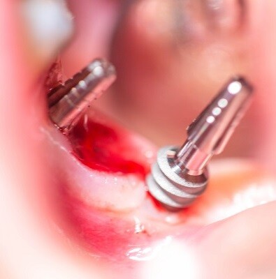 Santamarta es el único profesional que realiza esta novedosa técnica en la Comunidad Valenciana.