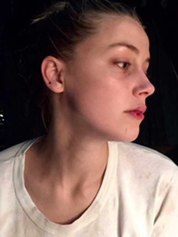 amber-heard-injuries-people-3-1