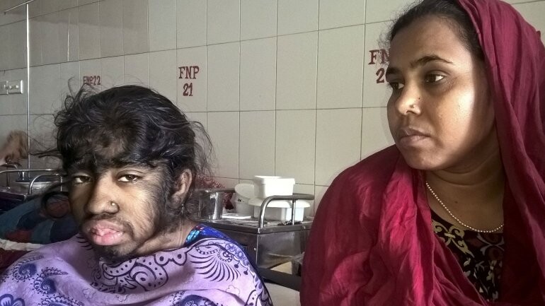 El drama de Bithi Akhtar, la niña lobo de Bangladesh (2)