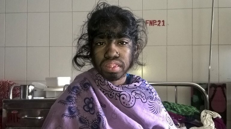 El drama de Bithi Akhtar, la niña lobo de Bangladesh (3)