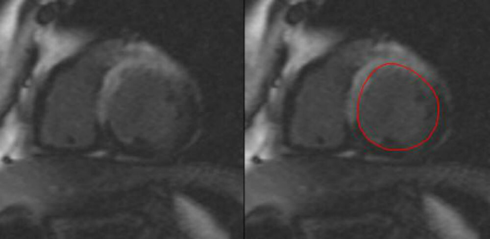 bonanad-cardiologia-corazón infartado