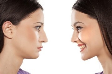 rinoplastia-en-valencia