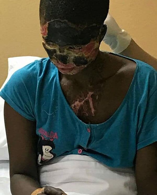 mujer-quemada-acido-etiopia-1