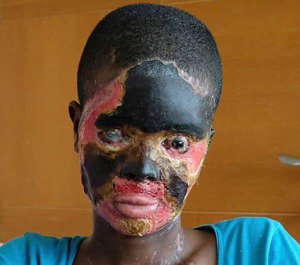 mujer-quemada-acido-etiopia-5