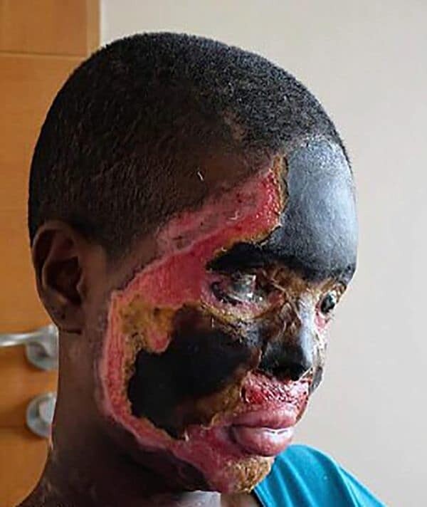 mujer-quemada-acido-etiopia-7 (1)